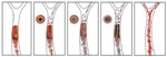Novel Nanotherapeutic Method Quickly Dissolves Clots Obstructing Blood Vessels in the Brain