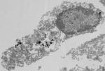 Researchers Use Semiconducting Nanoparticles to Destroy Tumor Cells Inside Eye