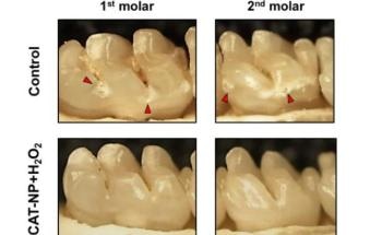 Researchers Use Iron-Containing Nanoparticles to Significantly Reduce Onset, Severity of Cavities