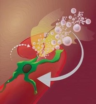 Combination Therapy for Cancer using Radiation and Nanoencapsulated Drugs