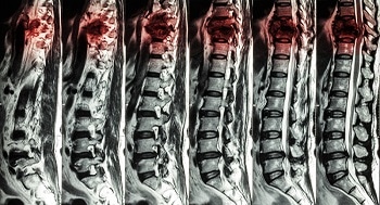 Nanoparticle-Based Injection Limits Damage in Spinal Cord Injury