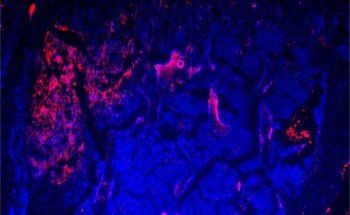 Nano-Based Chemotherapy Targets Tumor Cells that Spread to Bone