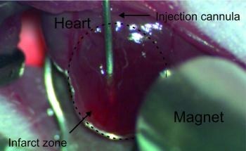 Nanoparticle-Loaded Cells Could Help Improve Heart Function Following Myocardial Infarction