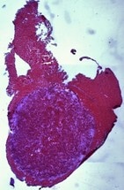 Nanosensor that Illuminates Tumors to be Tested in Surgeries
