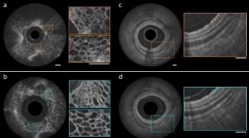 High-Resolution Nano-Optic Endoscope for Better Disease Detection
