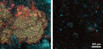 Nanoparticle Mouthwash May Reduce Tooth Plaque