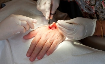 Novel Nanoneedle Patch Could Enable Delivery of Biomolecules with Minimal Invasiveness