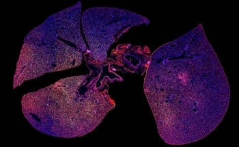 Novel Nanoparticle-Based Technology Could Improve Speed and Effectiveness of Pneumonia Diagnosis