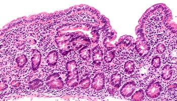Potential Nanotechnology Treatment for Celiac Disease Revealed