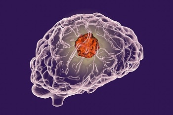 Air Pollution Nanoparticles and Their Link to Brain Cancer