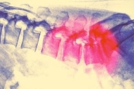 Nanoparticle Drug Delivery Method Shows Potential to Effectively Target Pancreatic Tumors