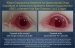 Renowned Japanese Corneal Researcher to Confirm NanoViricides Ekc-Cide Animal Study Results