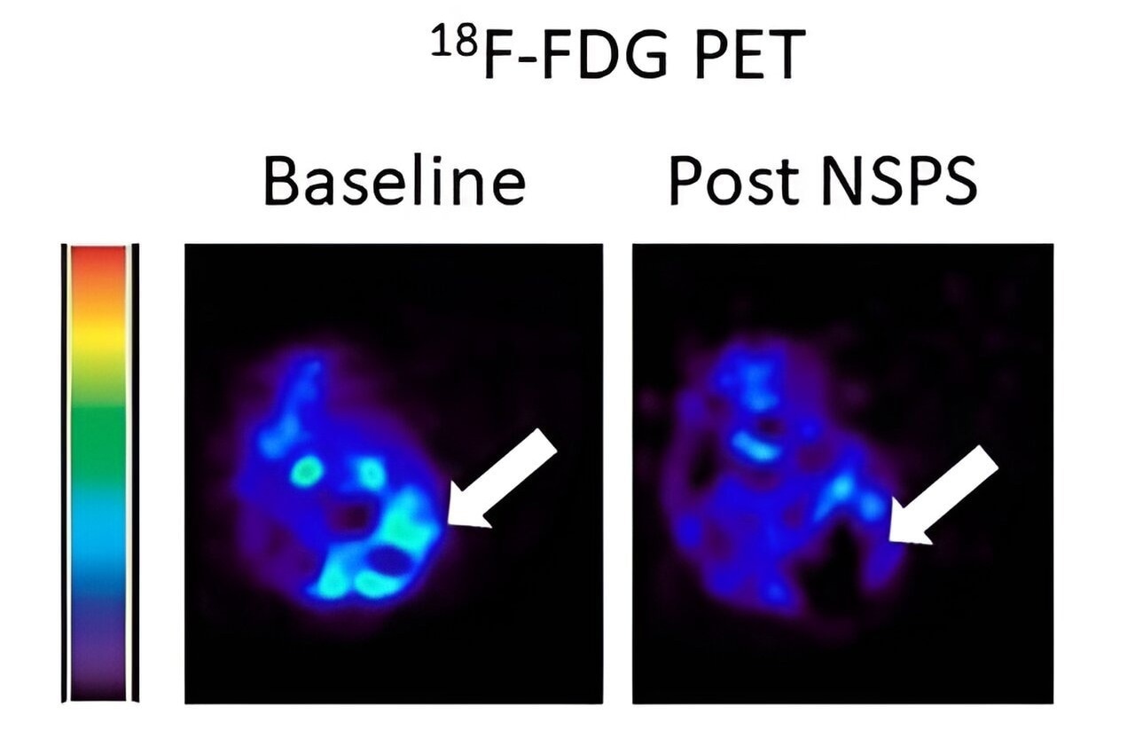 Novel Tumor Therapies by Targeting Extracellular Hydroxyapatite