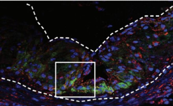 Can Nanoparticles Help Get Rid of Heart Attack Causing Plaques?