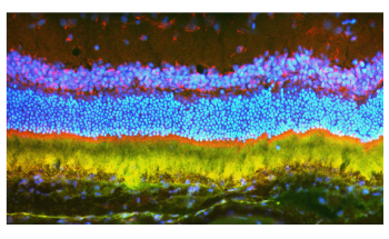Nanoparticles Used to Deliver Gene Therapy for Macular Degeneration