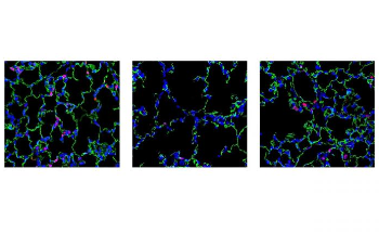 Nanoparticle-Based Therapy Could Treat Fatal Lung Disease in Newborns