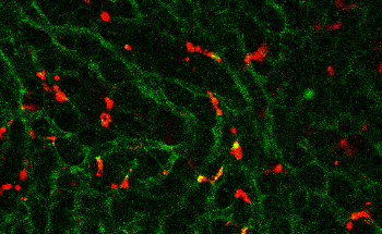 New Lipid Nanoparticles Could Help Overcome Resistance to Anti-Tumor Immunotherapy