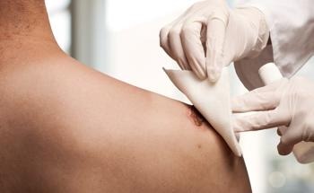 Curcumin Nanoparticle Dermal Patches for Enhanced Wound Healing
