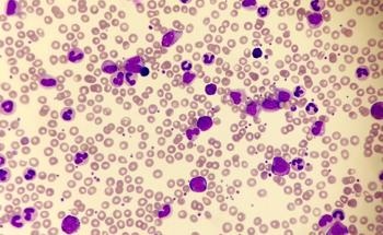 MXene Analytical Tool to Diagnose Chronic Myeloid Leukemia