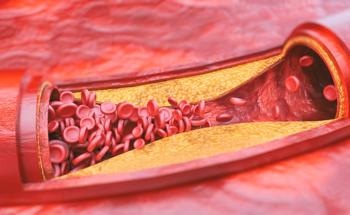 Nanomaterials Highlighted as Key Player in Atherosclerosis Therapeutics