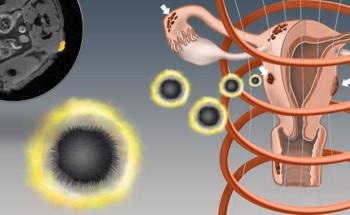 Study Shows Novel Nanoparticles Can Locate and Eradicate Endometriosis Lesions
