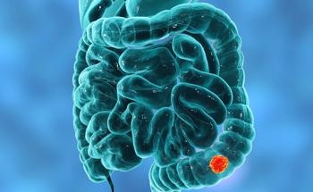 Colorectal Cancer Drug Delivery System Combines Nanoparticles and Hyaluronic Acid