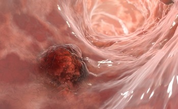 Semiconducting Polymer Nanoparticles to Target Deep-Tissue Tumors
