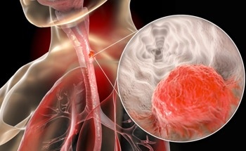 Novel Nanoplatform Found Effective Against Esophageal Cancer