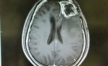 Glioblastoma Targeting Cell Membrane Nanovesicles