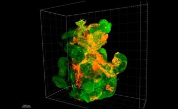 Treatment Strategy for Pancreatic Cancer Based on Nanoparticles