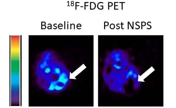 Novel Tumor Therapies by Targeting Extracellular Hydroxyapatite