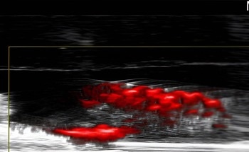 Harnessing Gold Nanoparticles for Biofilm Disruption
