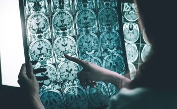 A Novel Noninvasive Method for Treating Alzheimer’s Disease