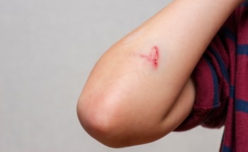 TRGO/ZnO Nanocomposites: A Promising Antibacterial Solution for Wound Healing