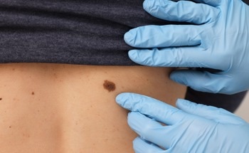 Nanoparticle-Based Combination Therapy for Resistant Melanoma