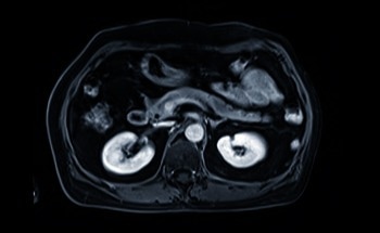 Novel Nanoplatform Overcomes Treatment Resistance in Bladder Cancer