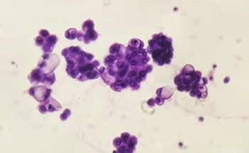 New Nanomedicine Approach Boosts Chemotherapy And Immune Activity In Pancreatic Cancer